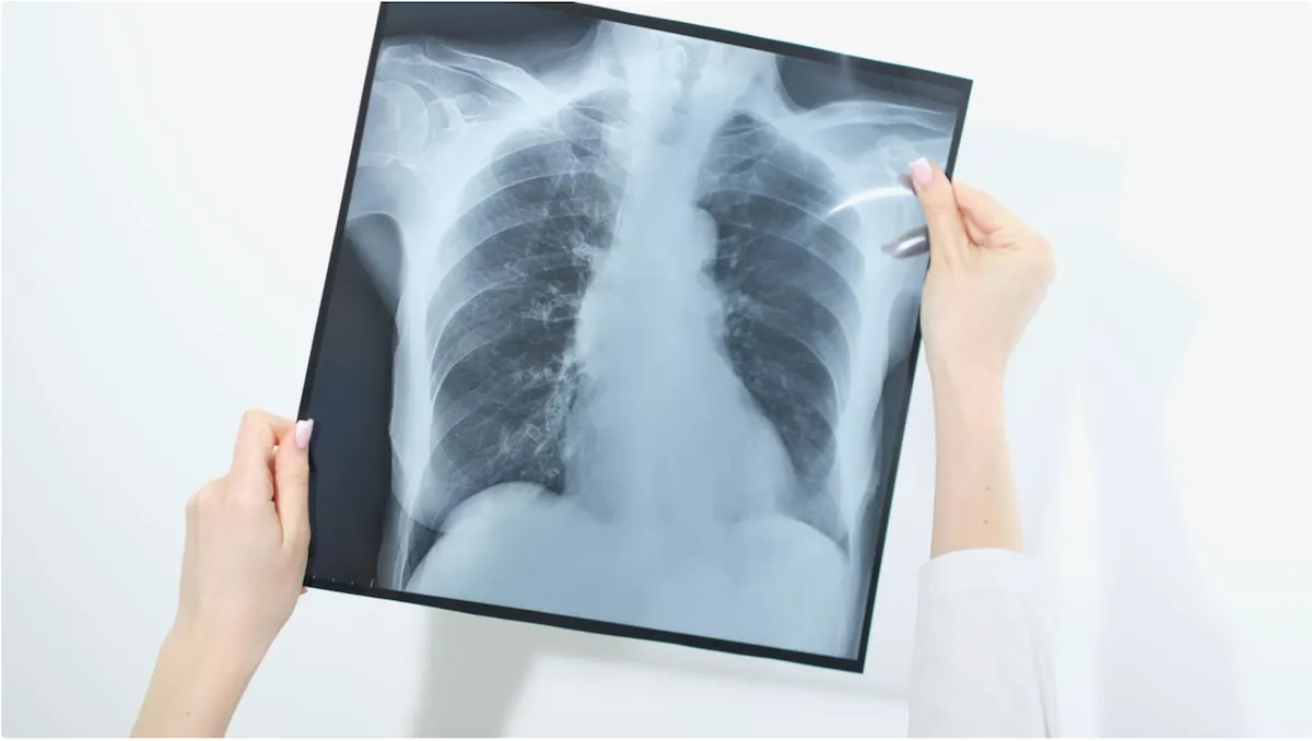 Investigación del MIT sugiere frenar el cáncer de pulmón